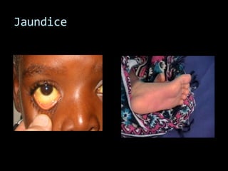 Jaundice
 