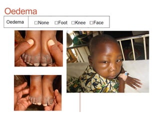 Oedema
 