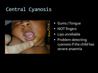 Central Cyanosis
 Gums /Tongue
 NOT fingers
 Lips unreliable
 Problem detecting
cyanosis if the child has
severe anaemia
 