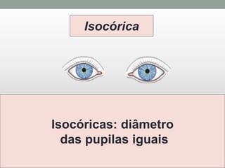 Isocórica
Isocóricas: diâmetro
das pupilas iguais
 