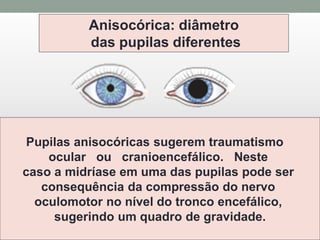Pupilas anisocóricas sugerem traumatismo
ocular ou cranioencefálico. Neste
caso a midríase em uma das pupilas pode ser
consequência da compressão do nervo
oculomotor no nível do tronco encefálico,
sugerindo um quadro de gravidade.
Anisocórica: diâmetro
das pupilas diferentes
 