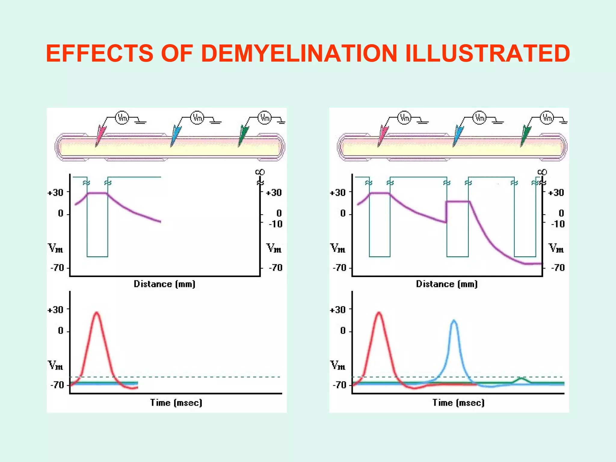 EFFECTS OF DEMYELINATION ILLUSTRATED 