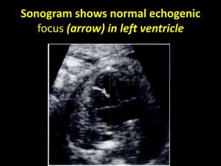 Sonogram shows normal echogenic
focus (arrow) in left ventricle
Dr/AHMED ESAWY
 