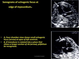 Sonograms of echogenic focus at
edge of myocardium.
• A, Four-chamber view shows small echogenic
focus (arrow) at apex of ...