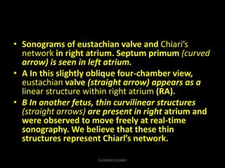 • Sonograms of eustachian valve and Chiari’s
network in right atrium. Septum primum (curved
arrow) is seen in left atrium....