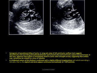• Sonograms of pseudooverriding of aorta. A, Long-axis view of left ventricular outflow tract suggests
discontinuity and o...