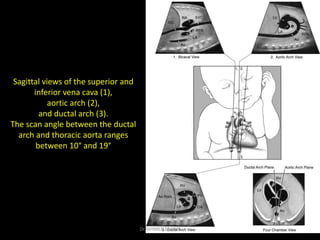 Sagittal views of the superior and
inferior vena cava (1),
aortic arch (2),
and ductal arch (3).
The scan angle between th...