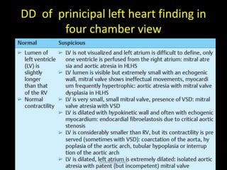 DD of prinicipal left heart finding in
four chamber view
Dr/AHMED ESAWY
 