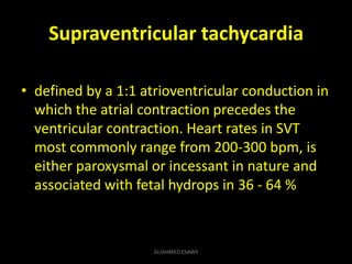 Supraventricular tachycardia
• defined by a 1:1 atrioventricular conduction in
which the atrial contraction precedes the
v...