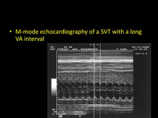 • M-mode echocardiography of a SVT with a long
VA interval
Dr/AHMED ESAWY
 