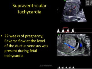 Supraventricular
tachycardia
• 22 weeks of pregnancy;
Reverse flow at the level
of the ductus venosus was
present during f...