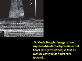 M-Mode Doppler images show
supraventricular tachycardia–atrial
heart rate (arrowhead) is fast as
well as ventricular heart...