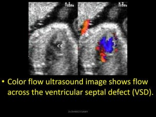 • Color flow ultrasound image shows flow
across the ventricular septal defect (VSD).
Dr/AHMED ESAWY
 