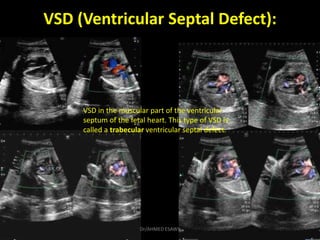 VSD (Ventricular Septal Defect):
VSD in the muscular part of the ventricular
septum of the fetal heart. This type of VSD i...