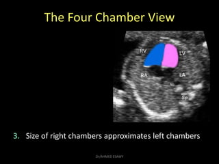The Four Chamber View
3. Size of right chambers approximates left chambers
Dr/AHMED ESAWY
 