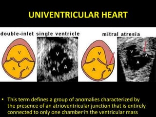 UNIVENTRICULAR HEART
• This term defines a group of anomalies characterized by
the presence of an atrioventricular junctio...