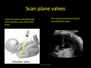 Scan plane valves
Angle the probe cephalad to get
the 4 chamber view of the fetal
heart.
The valvular movement should
simu...