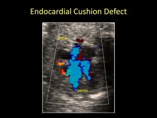 Endocardial Cushion Defect
vents
atria
Dr/AHMED ESAWY
 