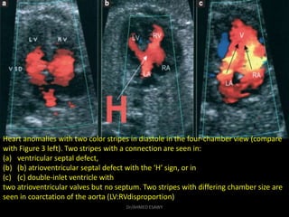 Heart anomalies with two color stripes in diastole in the four-chamber view (compare
with Figure 3 left). Two stripes with...