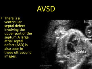 AVSD
• There is a
ventricular
septal defect
involving the
upper part of the
septum.A large
atrial septal
defect (ASD) is
a...