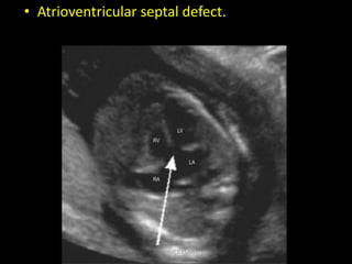 • Atrioventricular septal defect.
Dr/AHMED ESAWY
 