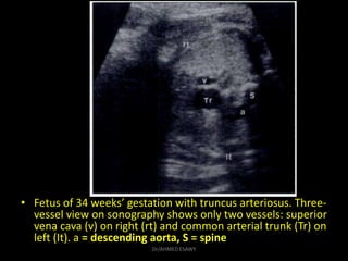 • Fetus of 34 weeks’ gestation with truncus arteriosus. Three-
vessel view on sonography shows only two vessels: superior
...