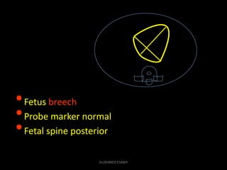 •Fetus breech
•Probe marker normal
•Fetal spine posterior
Dr/AHMED ESAWY
 