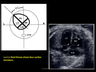 normal fetal thorax shows four cardiac
chambers.
Dr/AHMED ESAWY
 