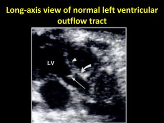 Long-axis view of normal left ventricular
outflow tract
Dr/AHMED ESAWY
 