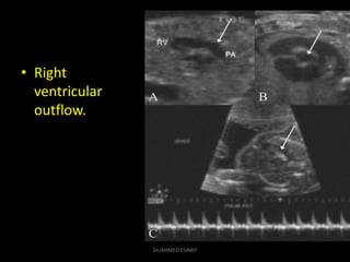 • Right
ventricular
outflow.
Dr/AHMED ESAWY
 