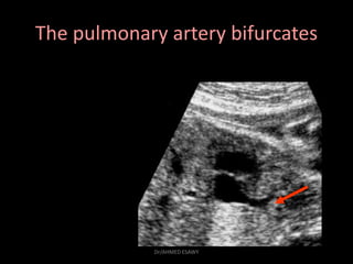 The pulmonary artery bifurcates
Dr/AHMED ESAWY
 