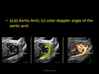 • (a,b) Aortic Arch; (c) color doppler angio of the
aortic arch
Dr/AHMED ESAWY
 