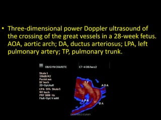 • Three-dimensional power Doppler ultrasound of
the crossing of the great vessels in a 28-week fetus.
AOA, aortic arch; DA...
