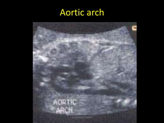 Aortic arch
Dr/AHMED ESAWY
 