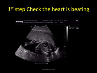 1st step Check the heart is beating
Dr/AHMED ESAWY
 