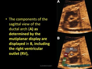 • The components of the
sagittal view of the
ductal arch (A) as
determined by the
mutiplanar display are
displayed in B, i...