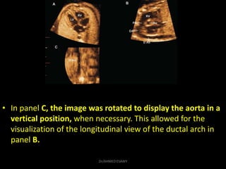 • In panel C, the image was rotated to display the aorta in a
vertical position, when necessary. This allowed for the
visu...