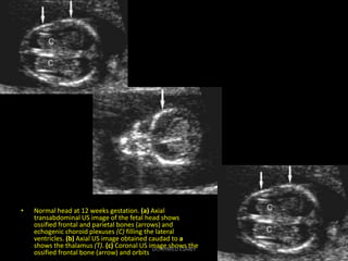 Vsd Color 2-Fetal Echo part 2 Dr Ahmed Esawy | PDF