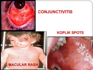 CONJUNCTIVITISKOPLIK SPOTS MACULAR RASH