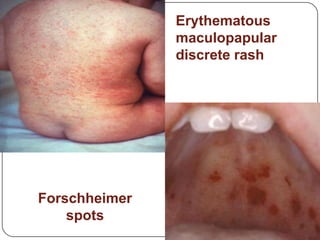 Erythematousmaculopapular  discrete rashForschheimer spots