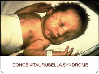 CONGENITAL RUBELLA SYNDROME