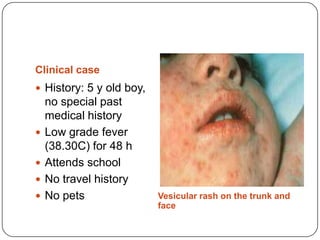 Clinical caseVesicular rash on the trunk and faceHistory: 5 y old boy, no special past medical historyLow grade fever (38.30C) for 48 hAttends schoolNo travel historyNo pets