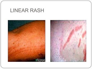 LINEAR RASH