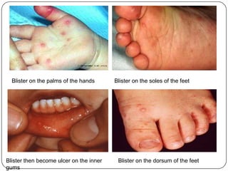 Hand,foot and mouth diseasemost often occurs in children under 10 years old. Causes: coxsackievirus A16, enterovirus 71 (EV71) and other enteroviruses. The enterovirus group includes polioviruses, coxsackieviruses, echoviruses and other enteroviruses.  more frequent in summer and early autumn (in temperate countries) 