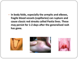  transmission: person-to-person by respiratory dropletscolonization of URT  penetrate into bloodstream  go to CNS and causing meningitis (meningococcal meningitis) / infect the blood vessel (meningococcemia)Meningococcemia / meningococcal septicaemia: