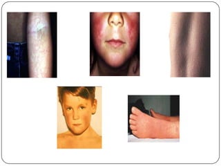 cutaneous signs:Maculopapular – early, often on a painful joint or pressure pointPetechiae (50-70%) – distribute at trunk and extremities (can be anywhere else)Purpura (may start anywhere on the body and then spread) and necrotic areaNon-cutaneous signs:  altered mental status, neck stiffness, irritability, nausea, vomiting, unstable vital signs, seizure. 