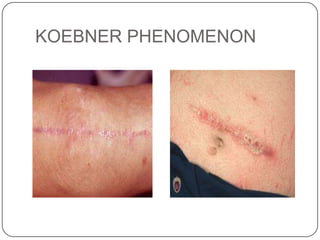 KOEBNER PHENOMENON