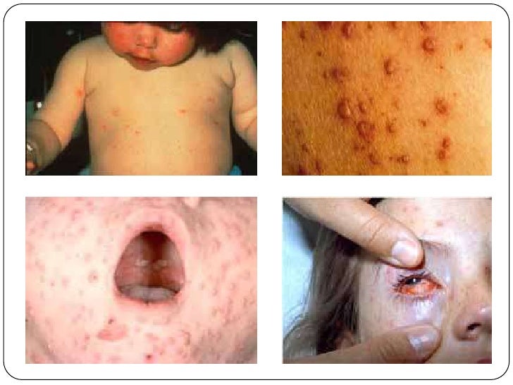 2 Fever With Rash
