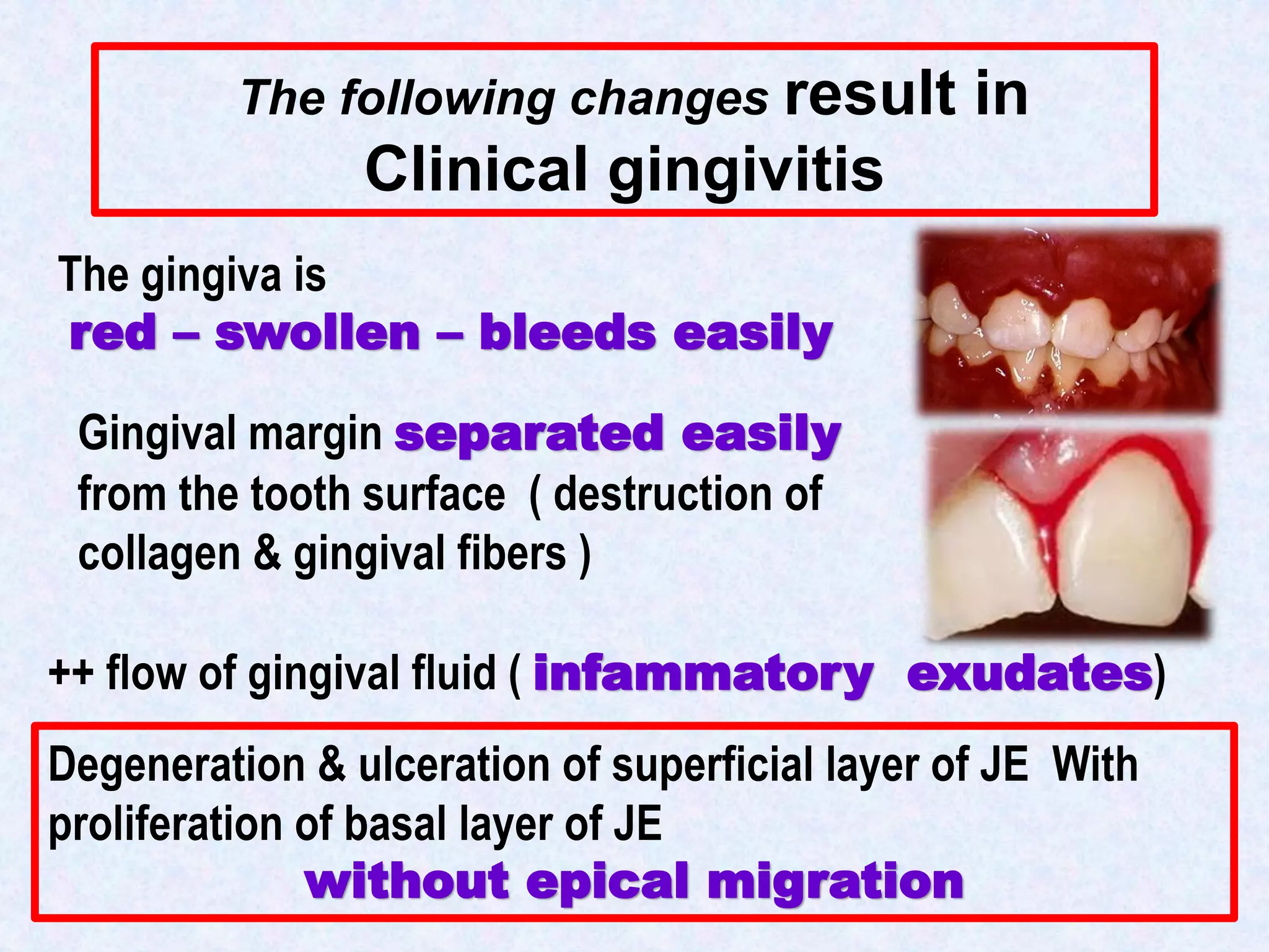 2- Gingivitis and periodontitis.pdf