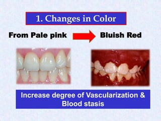 2- Gingivitis and periodontitis.pdf